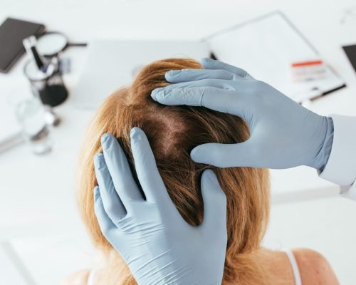 overhead view of dermatologist in blue latex gloves examining hair of patient in clinic